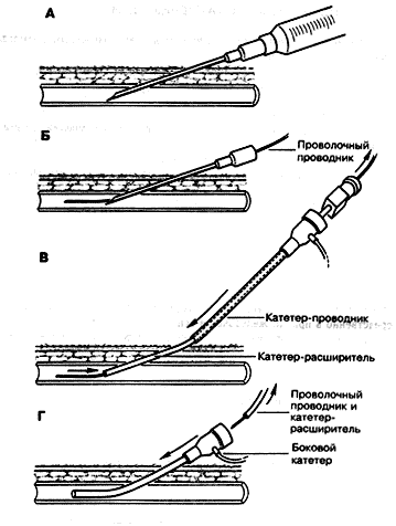 Схема постановки внутривенного катетера