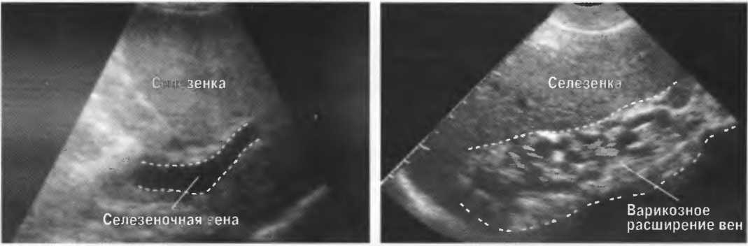 Расширенная селезенка. Селезеночная Вена на УЗИ норма. Селезёночная Вена УЗИ печени. Спленомегалия селезенки УЗИ.