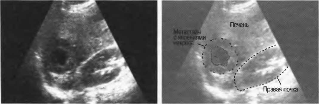 Метастазы в печени на узи