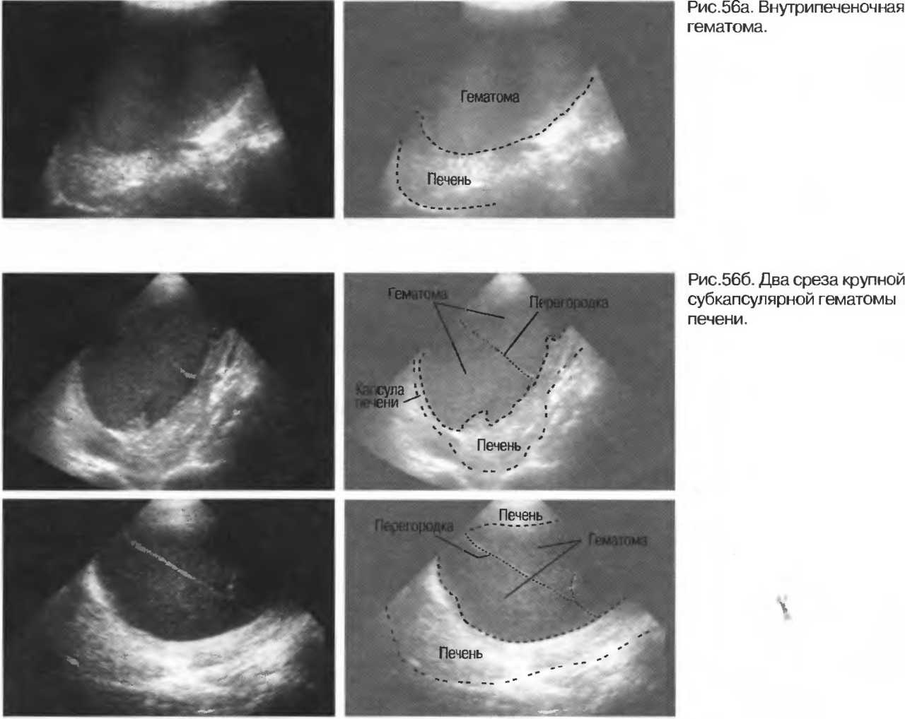 Гематома печени. Субкапсулярная гематома печени УЗИ. Подкапсульная гематома печени по УЗИ.
