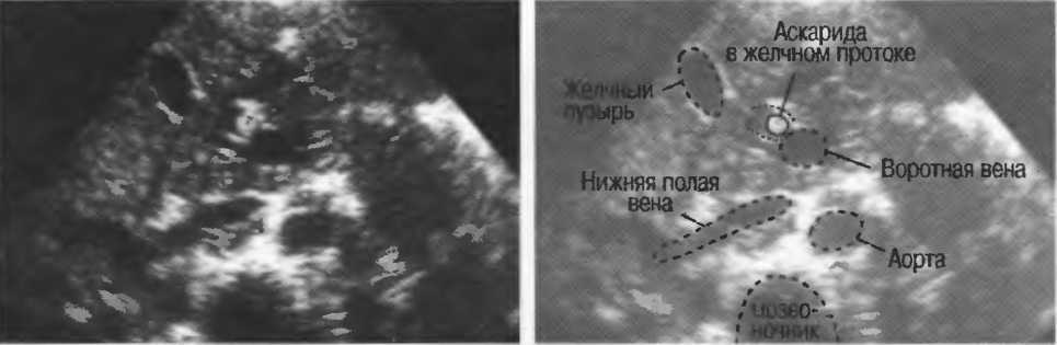 Можно ли на узи увидеть. Аскаридоз рентген брюшной полости. Аскаридоз желчного пузыря УЗИ.