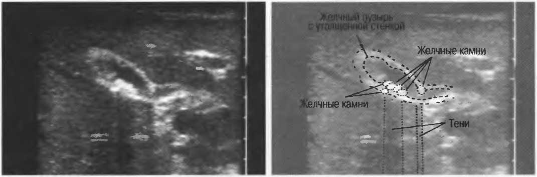 Узи стенок. Деструкция стенки желчного пузыря. Деструкция стенки желчного пузыря на УЗИ. Слоистая стенка желчного пузыря. Передняя стенка желчного пузыря на УЗИ.