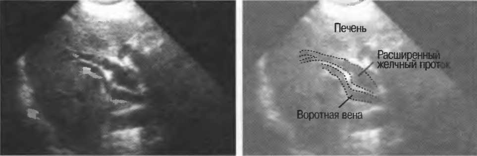 Расширение протоков печени. Общий желчный проток на УЗИ.
