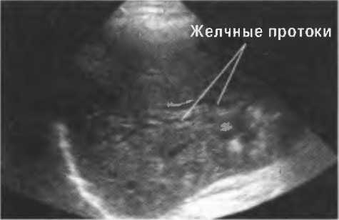 Расширение протоков печени. Расширение желчных протоков на УЗИ. Внутрипеченочные желчные протоки расширены на УЗИ. Расширение холедоха на УЗИ.