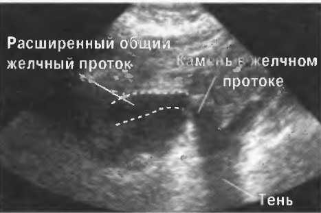 Расширение протоков