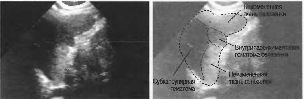 Гематома печени. Субкапсулярная гематома печени УЗИ. Подкапсульная гематома селезенки на УЗИ. Подкапсульная гематома селезенки на кт.