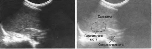 Эхинококковая киста селезенки. Киста селезенки что делать. Киста селезенки что делать. Киста селезенки что делать. Киста селезенки что делать.