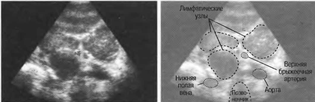 Мезентериальные лимфатические узлы у детей