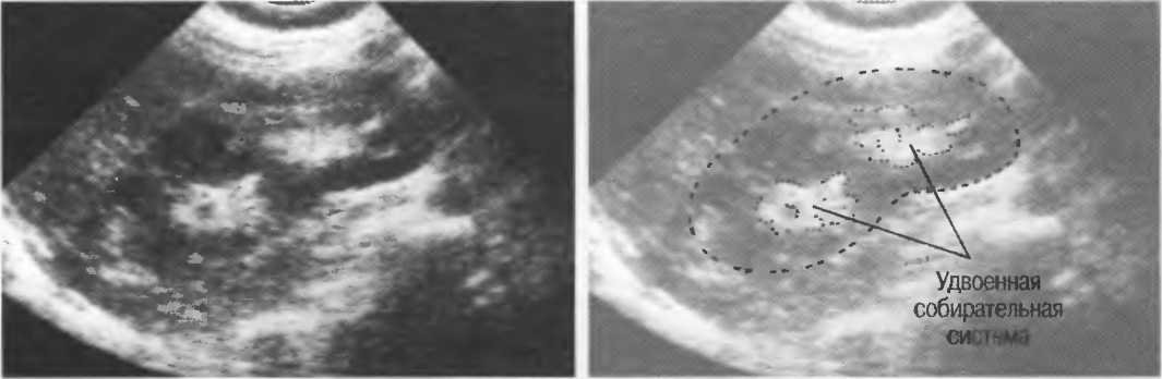 Удвоение почки. УЗИ почек удвоение ЧЛС. Неполное удвоение ЧЛС почки на УЗИ. Удвоение почки УЗИ протокол. Удвоение почки на УЗИ описание.