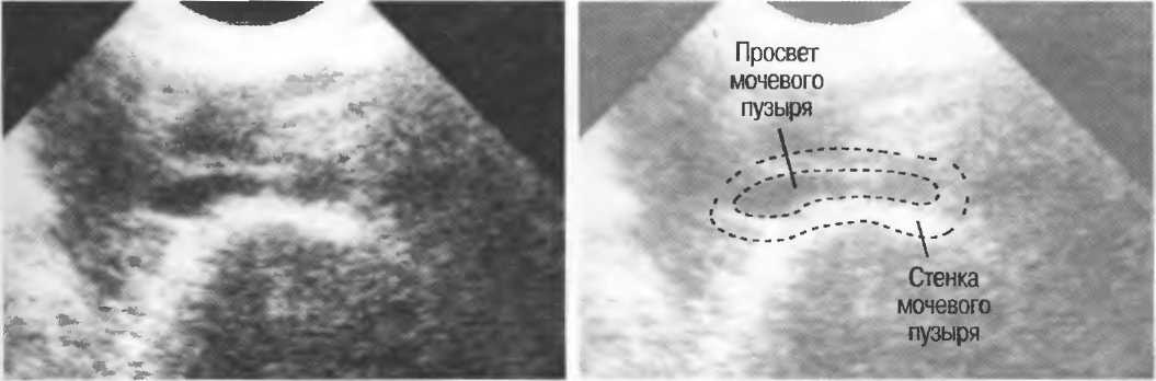 Стенки мочевого пузыря. Толщина стенки мочевого пузыря. Просвет мочевого пузыря. Эхография мочевого пузыря продольный срез. Трабекулярность стенки мочевого пузыря УЗИ.