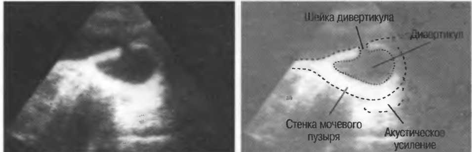 Трабекулярная стенка мочевого