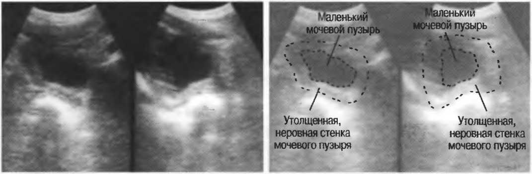 Маленький мочевой пузырь у мужчин