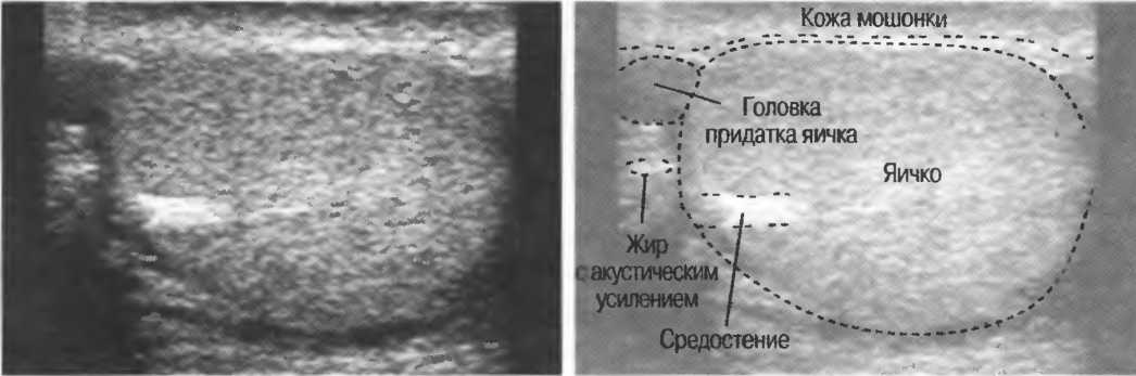 Узи яиц. Анатомия придатка яичка на УЗИ. Головка придатка яичка на УЗИ. Привесок придатка яичка на УЗИ.