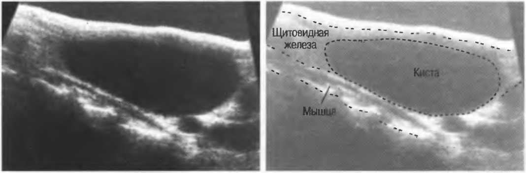 Микрокальцинаты яичек