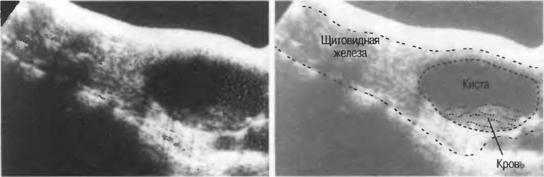 Гиперэхогенные включения с акустической тенью. Гиперэхогенная бляшка. Гиперэхогенная поджелудочная железа что это такое. Киста в щитовидной железе фото.