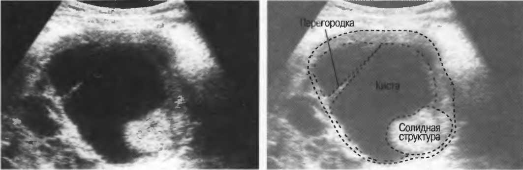 Кистозно солидное образование яичника что это