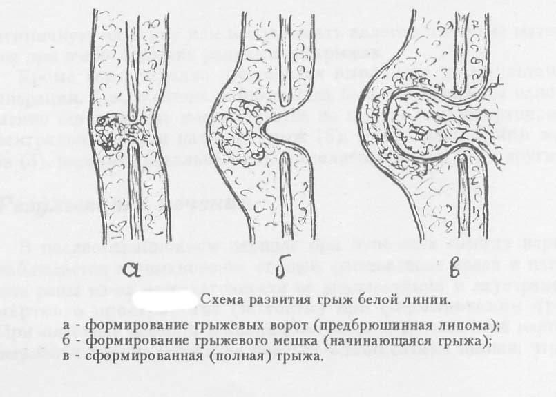 Грыжа Живота Симптомы Фото