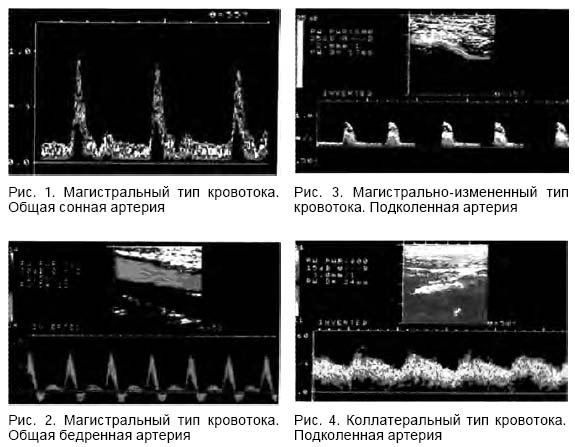 кровоток магистрально измененный. магистральный и коллатеральный тип кровотока на узи. магистральный и коллатеральный тип кровотока. магистральный и коллатеральный тип кровотока. магистрально-измененный тип кровотока артерий нижних конечностей.