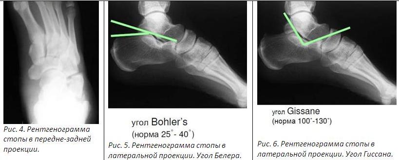 Кости угол. Перелом пяточной кости угол Белера. Угол Белера при переломе пяточной кости. Угол Беллера пяточной кости при переломе. Угол пяточной кости при переломах.
