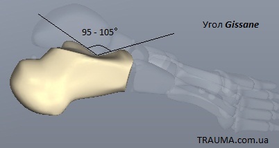 Кости угол. Перелом пяточной кости угол Белера. Пяточная кость угол Беллера. Угол Беллера пяточной кости. Угол Белера при переломе пяточной кости.