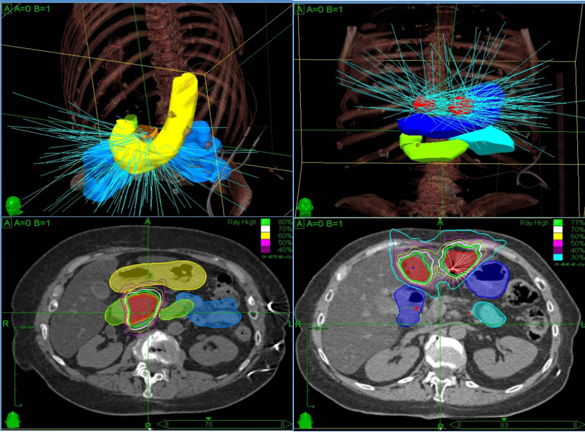 Рак поджелудочной лучевая терапия. Олигометастатическая болезнь. Кибер нож при метастазах в легких. Чипы для лучевой терапии в онкологии.