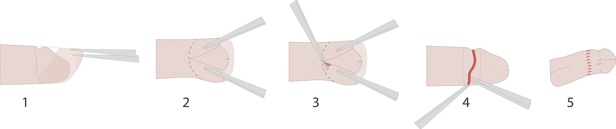 Можно ли с открытое головкой. Операция фимоз ход операции. Циркумцизио (обрезание крайней плоти) (схема 2).